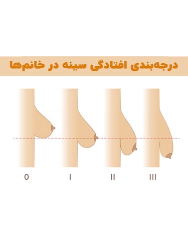 افتادگی-سینه-min افتادگی-سینه-min